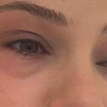 Flormar Volume Up Maskara'da Şiddetli Alerjik Reaksiyon Ve Acil Tıbbi Müdahale