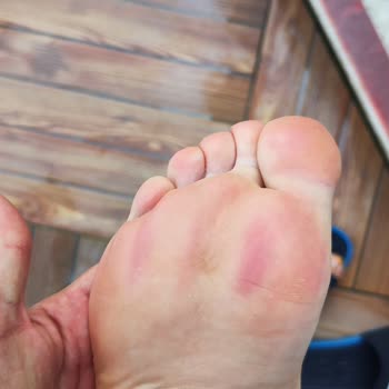 Sandalias Fila Causan Moretones y Dolor Intenso en Pies, Solicito Cambio