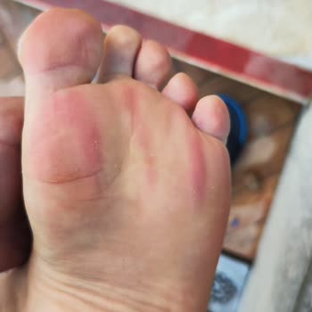 Sandalias Fila Causan Moretones y Dolor Intenso en Pies, Solicito Cambio