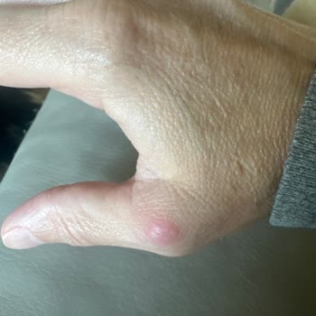 Dyson V15 Grip Causes Thumb Pain