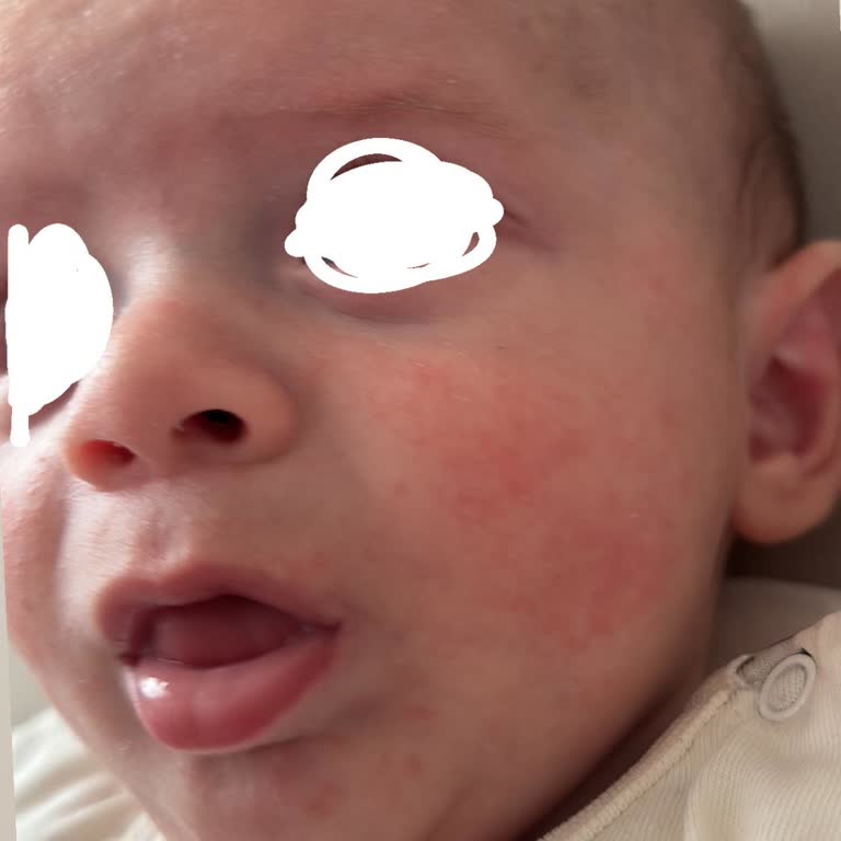 Mustela Ürünü Bebek Cildinde Egzama Alevlendirdi İade Talebi