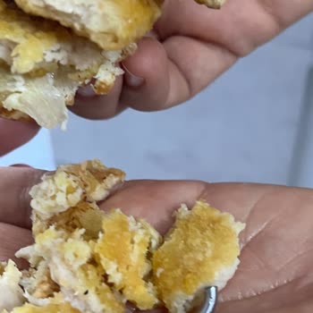 Burger King Hamburgerinde Metal Parça Bulunması Ve Diş Hasarı