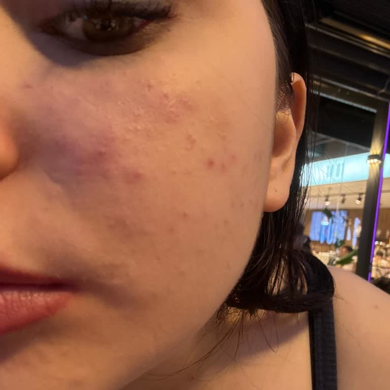Hijyen Kurallarına Uyulmaması Ve Cilt Yanığı Nedeniyle 2500 TL İadesi Talebi