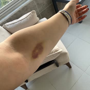 Kahramanmaraş'ta HG Hastanesinde Kan Alımında İki Damar Patladı Ve Kol Üzerinde Morluk