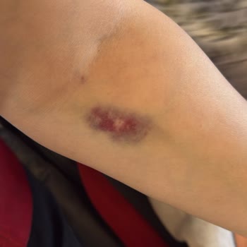 Kahramanmaraş'ta HG Hastanesinde Kan Alımında İki Damar Patladı Ve Kol Üzerinde Morluk