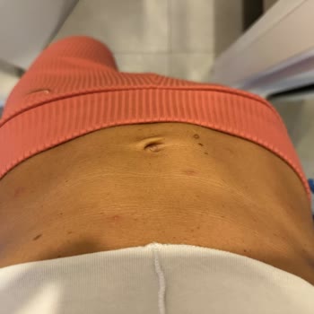 Lizbon Otel’de Kızımın Tahta Kuruşu Isırıkları Ve Sağlık Riski