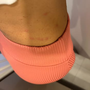 Lizbon Otel’de Kızımın Tahta Kuruşu Isırıkları Ve Sağlık Riski