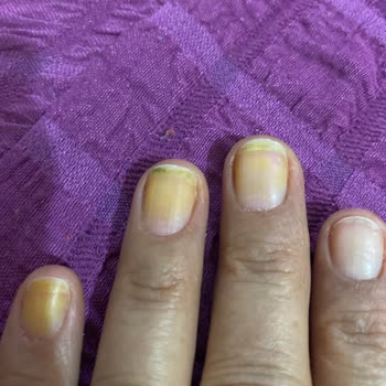 Pastel 405 Oje Kullanım Sonrası Sarı İz Bırakması Ve Cilt Sağlığı Endişesi