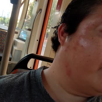 Böcek Isırıkları Ve Alerjik Reaksiyon Hijyen İhmali Ve Umursamaz Personel