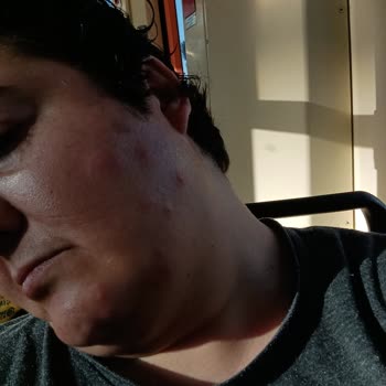 Böcek Isırıkları Ve Alerjik Reaksiyon Hijyen İhmali Ve Umursamaz Personel