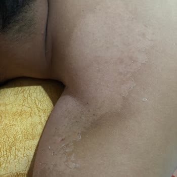 Bioxcin Güneş Kremi Korumasız Bıraktı Ve Ağır Yanıklara Neden Oldu