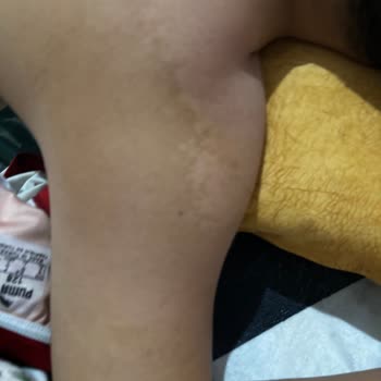 Bioxcin Güneş Kremi Korumasız Bıraktı Ve Ağır Yanıklara Neden Oldu