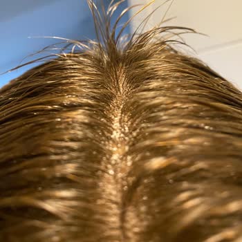 Açıcı Fazla Kaldığı İçin Saçım Koptu, Salon Sorumluluk Almıyor Ve İade İstiyorum