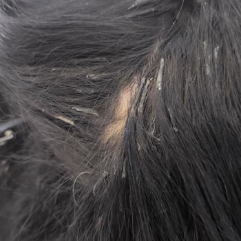 Mert Yıldırım Türk Hair House Yapılan İşlemden Kesinlikle Memnun Kalmadım