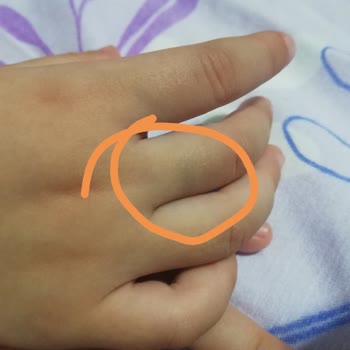 Çocuk Yüzüğünün Hızlı Paslanması Ve Cilt Tahrişi