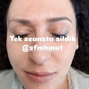 Yanıltıcı Reklam Ve Gerçekleşmeyen Kaş Silme Vaadi Nedeniyle Ücret İadesi Talebi