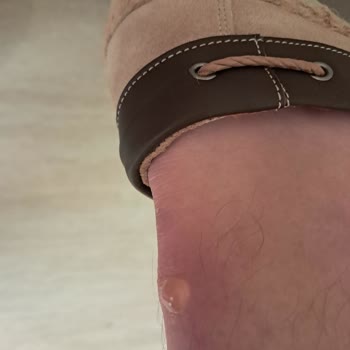 Ayakkabı Yaralanması Ve İade Talebine Cevap Vermeyen Mağaza