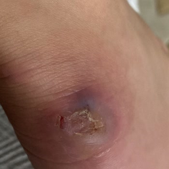 Ayak Yaralanmasına Sebep Olan Nike Jordan Ayakkabısı İçin İade Talebi