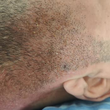 Clozaril Jel Kullanımında Şiddetli Yan Etki Yüz Ve Boyunda Şişmeye Yol Açtı