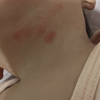 Hepsiburada'dan Aldığım Bioderma Kremi Sahte Ve Ciltte Alerjik Reaksiyon
