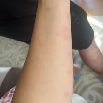 Tree Home Sapanca’da Tahtakurusu Ve Hijyen Sorunları Nedeniyle Tam Ücret İadesi Talebi