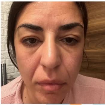 Neutrogena Collagen Bank Kremi Şiddetli Alerjik Reaksiyon Ve Hastane Tedavisi Gerektirdi