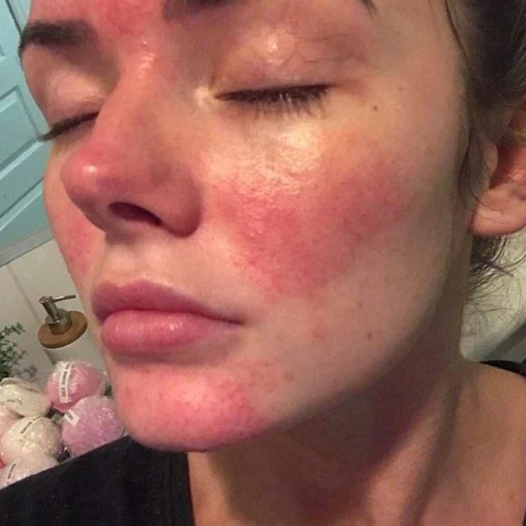 Severe Allergic Reaction From Sheglam Cosmetics
