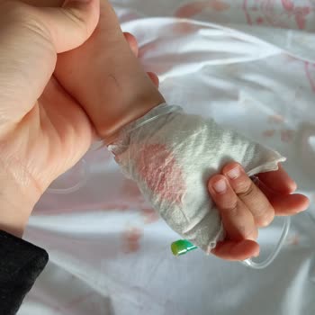 Manisa Şehir Hastanesinde Çocuk Damar Yolu Tahrişi Ve Gecikmiş Müdahale