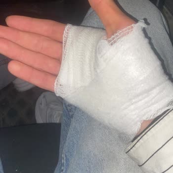 Keskin Kenarlı Konserve Açarken Elime Dikiş Atıldı
