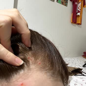 L'Oréal Paris Saç Boyasında Alerjik Yanma Ve Ücret İadesi Talebi