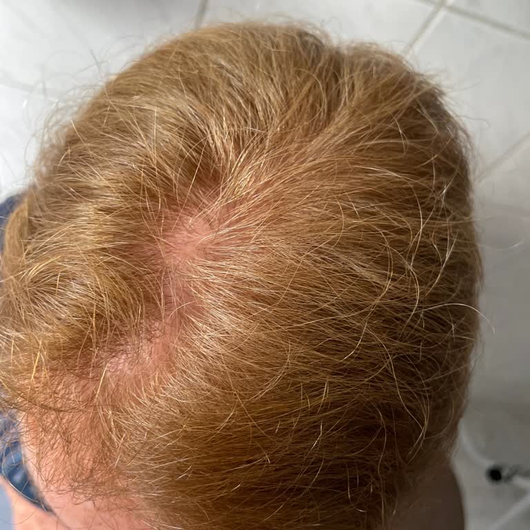 Koleston Hair Dye Causes Severe Itching and Forehead Swelling