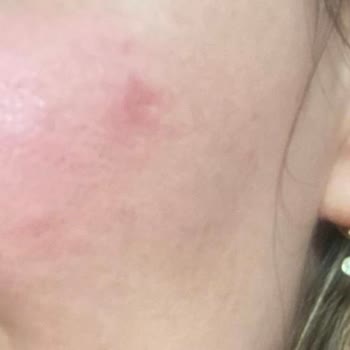 Clinimed Nişantaşı Fractional Laser Treatment Caused Burn-Like Marks and Skin Discoloration