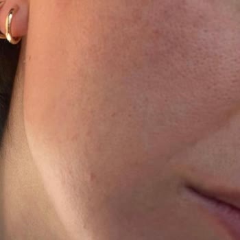 Clinimed Nişantaşı Fractional Laser Treatment Caused Burn-Like Marks and Skin Discoloration