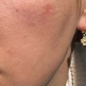 Clinimed Nişantaşı Fractional Laser Treatment Caused Burn-Like Marks and Skin Discoloration
