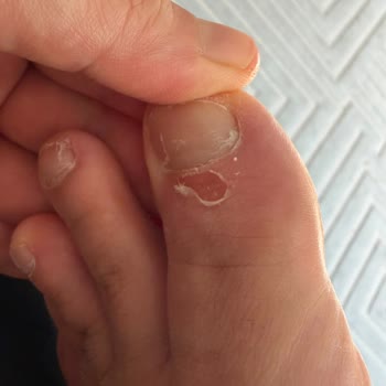 Cilt Tahrişi Ve Yara Oluşturan Sandalet