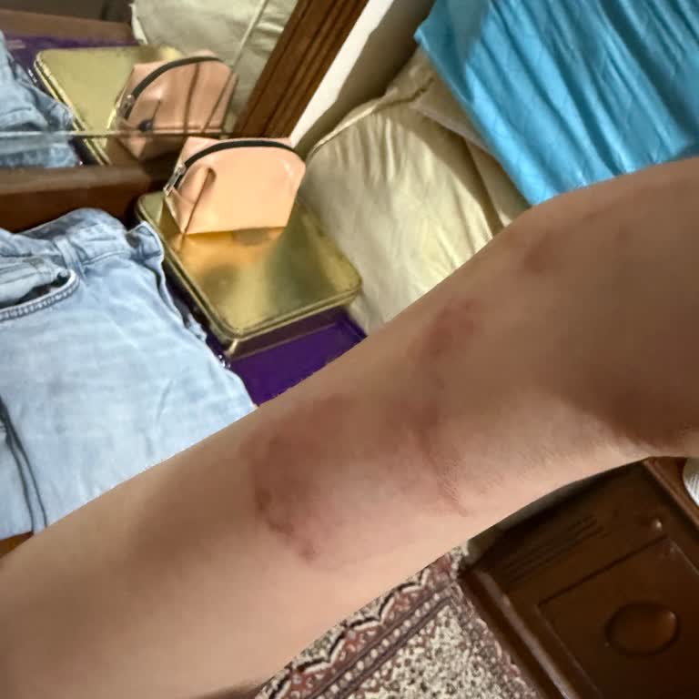 Rukiye Aydın Beauty 2. Seans Sonrasında Tüm Vücudum Yandı