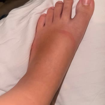 Ayakkabıda Su Toplanması Ve Tahriş Nedeniyle İade Talebi
