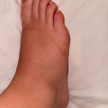Ayakkabıda Su Toplanması Ve Tahriş Nedeniyle İade Talebi