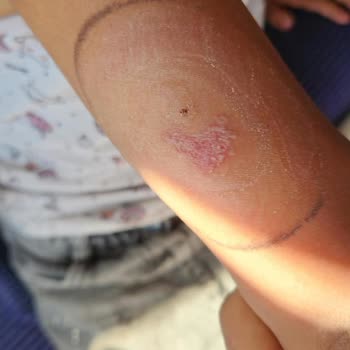Sensör Ölçüm Hataları Ve Cilt Lezyonu Şikayetim