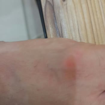 Skechers Ayakkabı İç Astarı Tahrişi, Değişim Ve İade Reddedildi