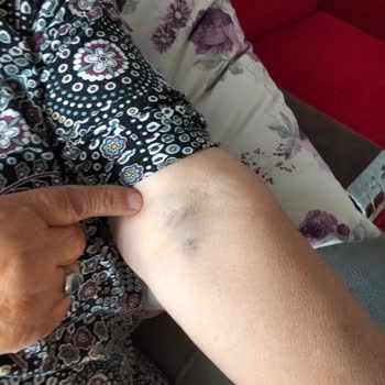 Tecrübesiz Hemşire Nedeniyle Annemin Kan Alımında Yaşadığı Sağlık Tehlikesi