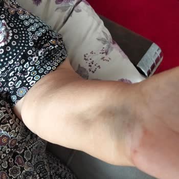 Tecrübesiz Hemşire Nedeniyle Annemin Kan Alımında Yaşadığı Sağlık Tehlikesi
