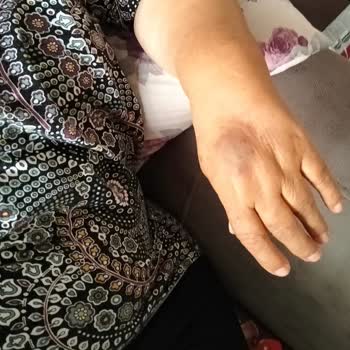 Tecrübesiz Hemşire Nedeniyle Annemin Kan Alımında Yaşadığı Sağlık Tehlikesi