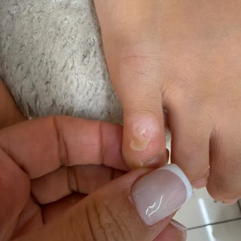 Intersport Adidas Çocuk Ayakkabısı Ayaklarını Yaraladı, İade Talebi