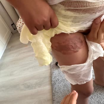 İşletmede Kaynar Çay Servisi Çocuğumuza Birinci Derece Yanık Verdi