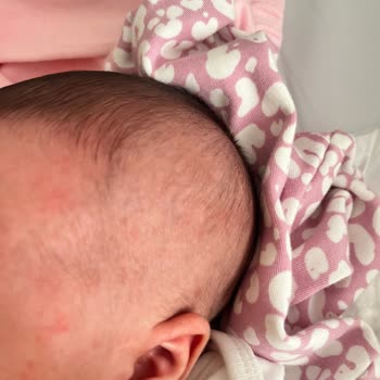 Ecowell Bebek Ürünleri Sonrası Şiddetli Kızarıklık Ve Döküntü