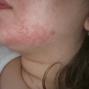 Nivea Derma Skin Clear'de Şiddetli Cilt Reaksiyonu Ve İade Talebi