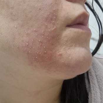 Nivea Derma Skin Clear'de Şiddetli Cilt Reaksiyonu Ve İade Talebi