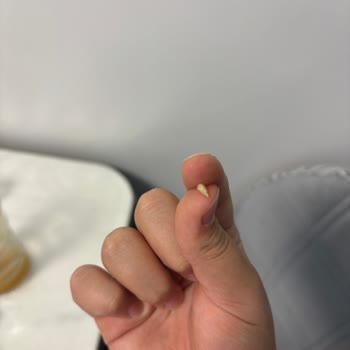 Dönerde Sert Beyaz Yabancı Cisim Dişimi Kırdı