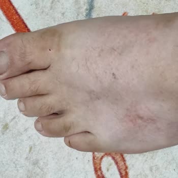 Ayak Sağlığını Bozan Terlik Üzerine İade Talebi